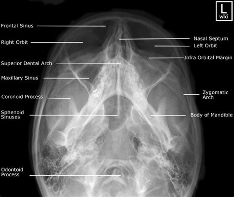 Alexandra sieroslawska md • reviewer: Facial Bones Radiographic Anatomy - wikiRadiography ...