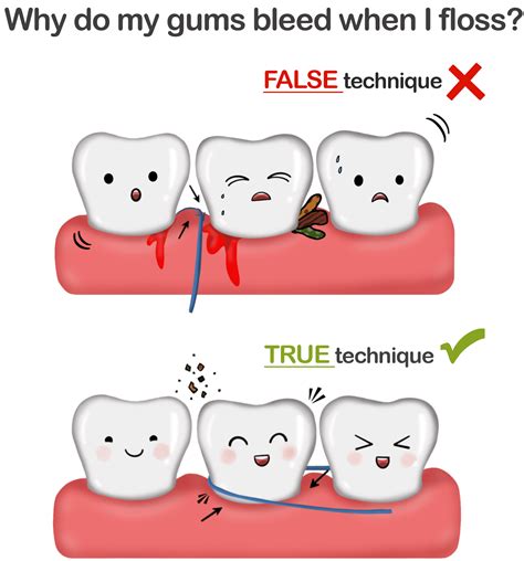 Why Do My Gums Bleed When I Floss Reasons And Solutions Explained