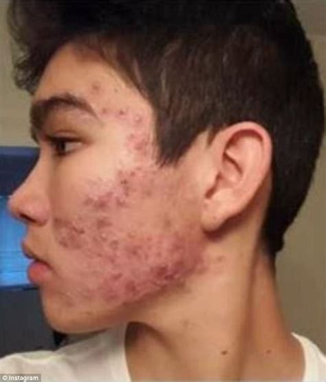 Teenage Boy Cleared Severe Acne With An 8 Moisturizer Express Digest