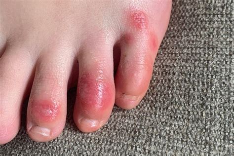 ‘covid Toes Other Rashes Are The Latest Rare But Possible Signs Of