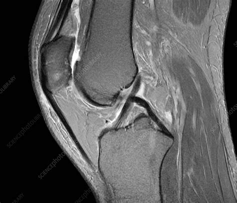 Normal Knee Mri Scan Stock Image C0261157 Science Photo Library
