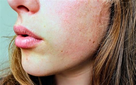 The Rosacea Treatment Process Your Easy 8 Step Guide