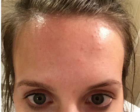 How I Cleared My Tiny Bumps On Forehead Once For All Forehead