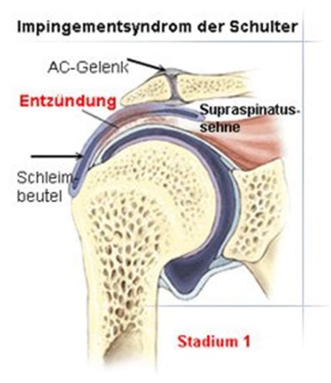 Jahrzehnte fast unmerklich entwickelt und kontinuierlich. Impingement-Syndrom :: Medizinisches Versorgungszentrum ...