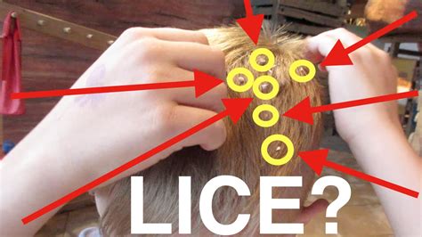 Kid Has Giant Head Lice Youtube