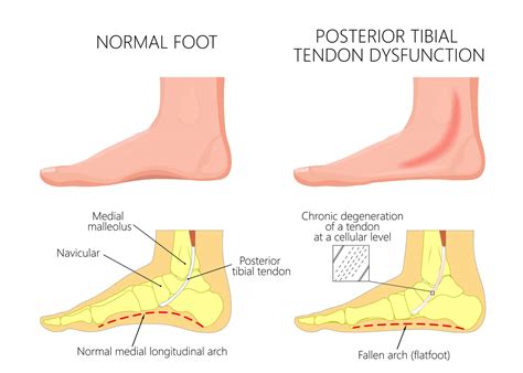Causes Of Inner Ankle Pain Explained By A Foot Specialist