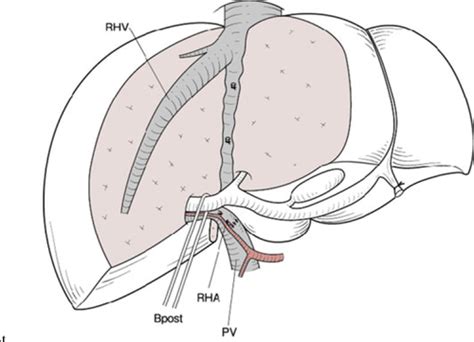 Left Hepatectomy Or Left Trisectionectomy With Resection Of The Caudate