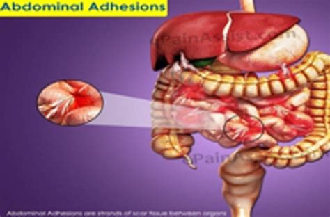 Internal Abdominal Scar Tissue Symptoms