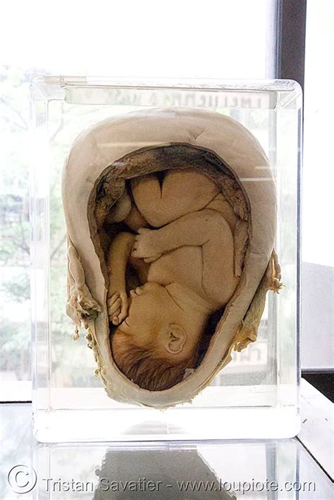 Dead Fetus In Womb Preserved ศพเด็ก Forensic Medicine Museum