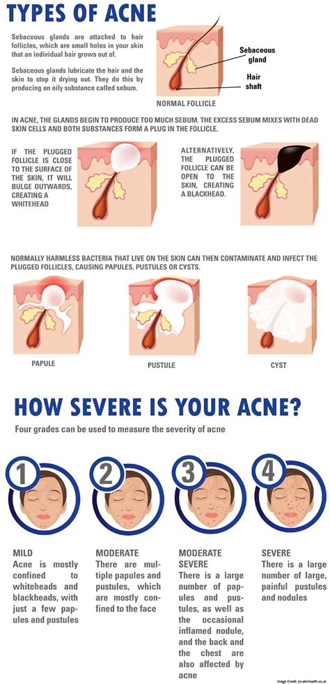 What Is Acne Types Causes Signs And Symptoms Treatment