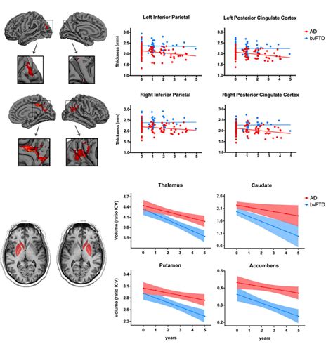 Mapping Brain Shrinkage In Dementia Atlas Of Science