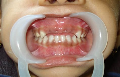 replacement  missing milk teeth children dentist dr anil patil