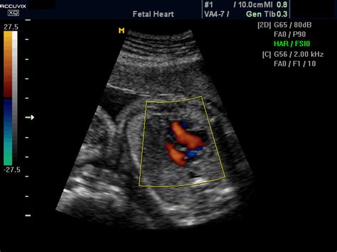 Ultrasound Images Fetal Heart Lvot Color Doppler Echogramm №392