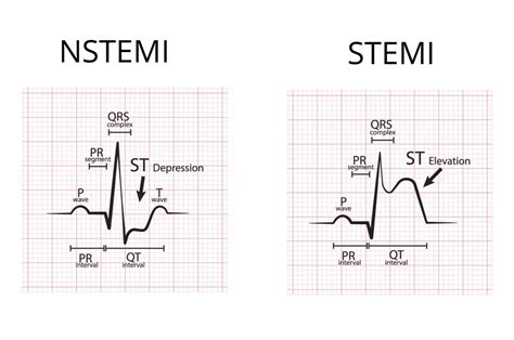 Gambar Ekg Stemi Nurhayana Situmorang