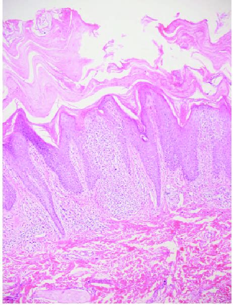 Severe Hyperkeratosis Psoriasiform Achantosis And Focal Spongiosis