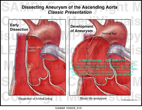 Dissecting Aneurysm Of The Ascending Aorta Medical Illustration