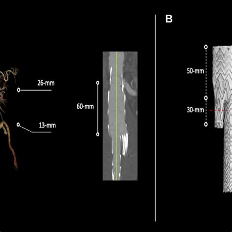 A Three Dimensional Reconstruction Of Preoperative Computed Tomography