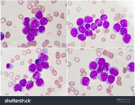 Leukemia Human Blood Cell Under Microscope 1000x Stock Photo
