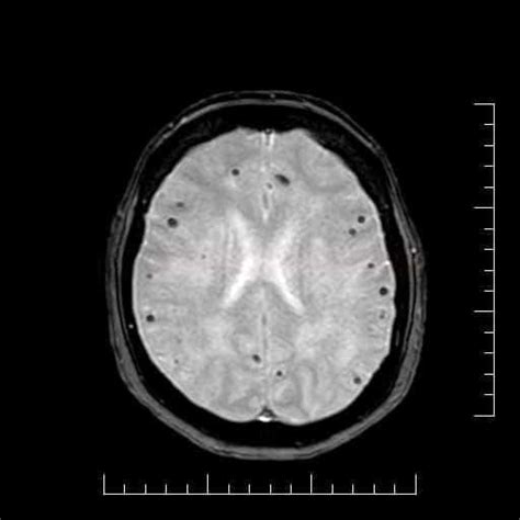 Cerebral Amyloid Angiopathy Caa Stroke Manual
