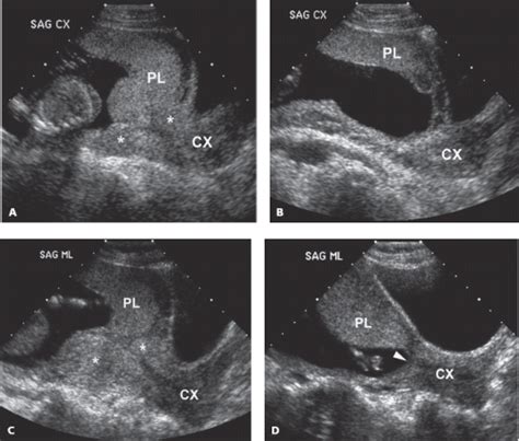 Placenta Obgyn Key