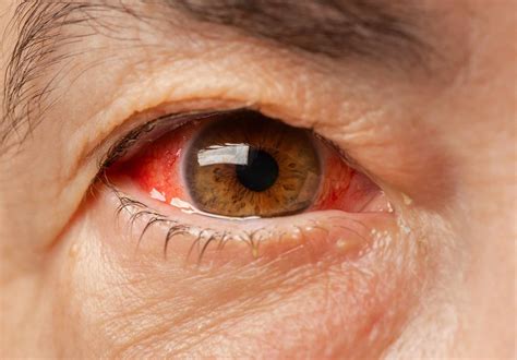 How To Help Bloodshot Eyes Soupcrazy1