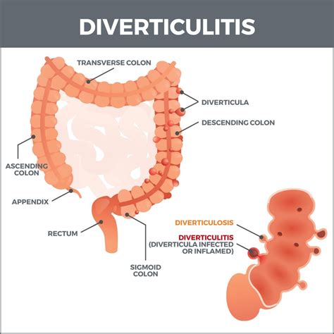 Diverticulosis And Diverticulitis Gastro MD