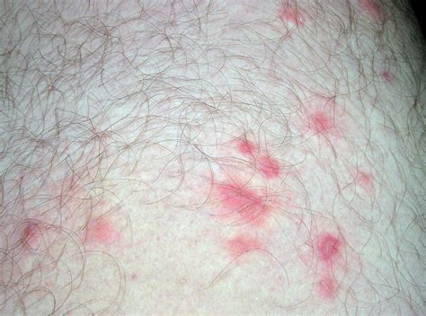 Chigger Bites Images 35 Effective Home Remedies To Get Rid Of Chigger