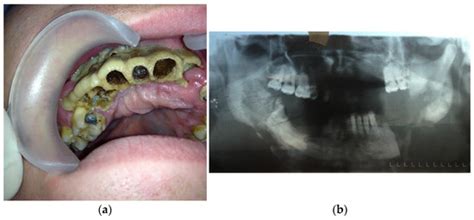 Dentistry Journal Free Full Text Surgical Treatment In Patients