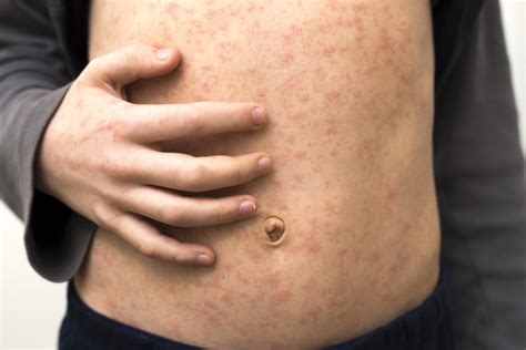 Coronavirus May Trigger A Measles Resurgence