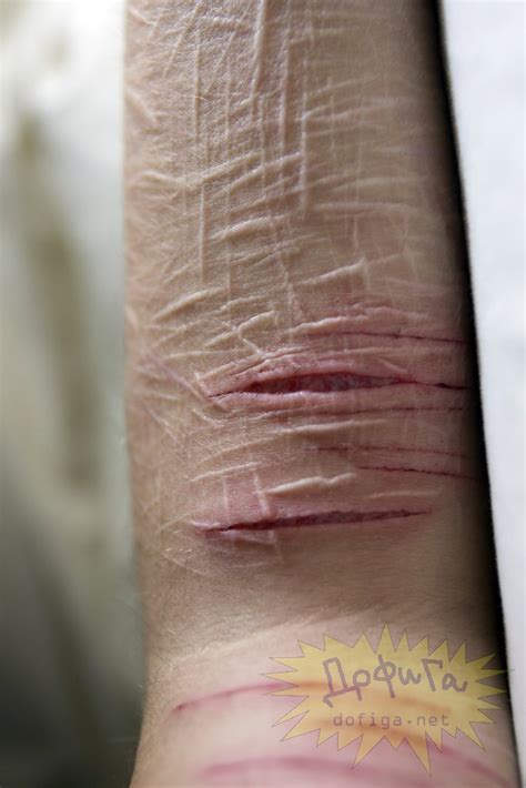 【閲覧注意】15歳の少女の「自傷行為」 18 Images ポッカキット