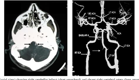 Vertebral Artery Dissection Intelligently Using CT Angiography With Vascular Reconstruction