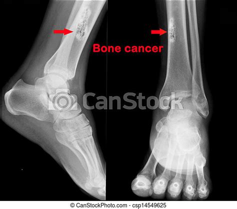 Stock Photo Of X Ray Of Bone Cancer X Ray Of Bone Cancer Csp14549625