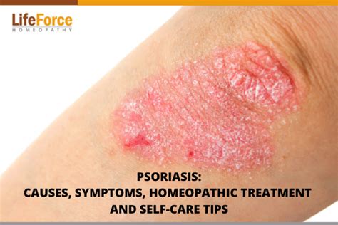 Psoriasis Causes Symptoms Homeopathic Treatment And Self Care Tips