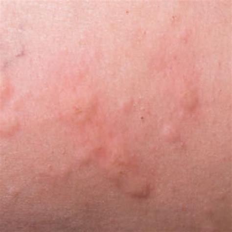 How To Identify 4 Common Skin Rashes Alergia Piel Picazon En La Piel