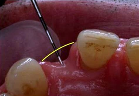 CirugÍa Oral Injertos óseos De Mentón Para La Reconstrucción De
