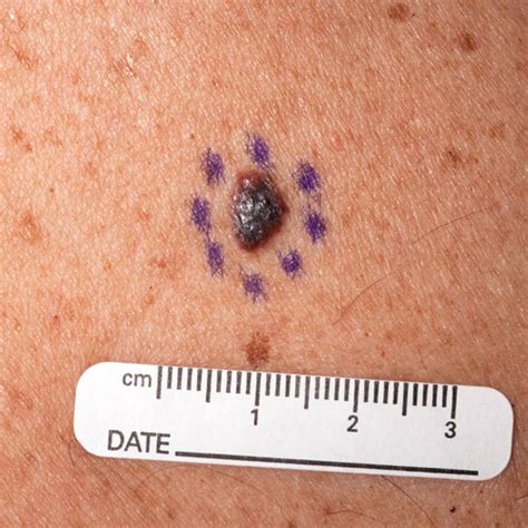 What Does Melanoma Look Like Images And Symptoms