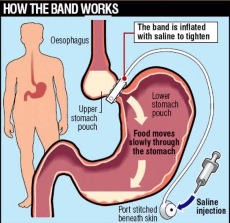 Gastric banding is a surgical treatment for obesity. Gastric Band Surgery - Who Can Get Lap Band Done?