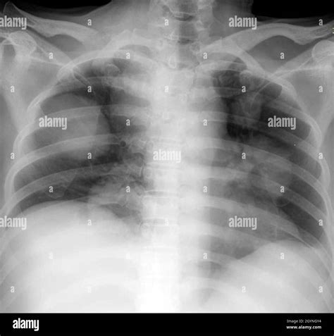 Secondary Lung Cancer X Ray Stock Photo Alamy