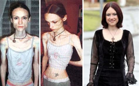 Before After Photos Of People Who Beat Anorexia True Activist