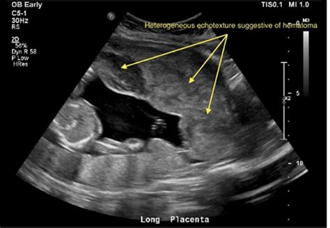 Placental Abruption On Ultrasound