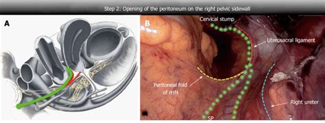 Pelvic Sidewall Anatomy