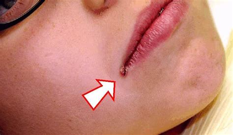 How Do I Get Rid Of These Sores In The Corners Of My Mouth Ask An