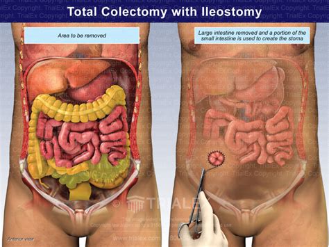 Total Colectomy With Ileostomy Trial Exhibits Inc