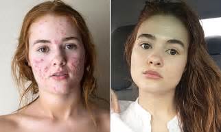 Ohio Woman Posts Before And After Acne Instagram Photos