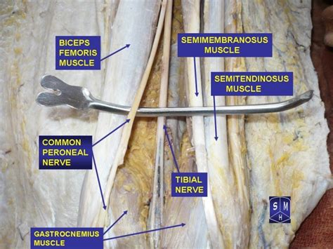 Common Peroneal Nerve Physiopedia
