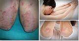 Any New Treatments For Psoriatic Arthritis Pictures