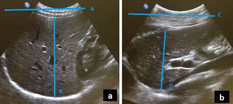 Methods Of Determining The Size Of The Adult Liver Using D Ultrasound A Systematic Review Of