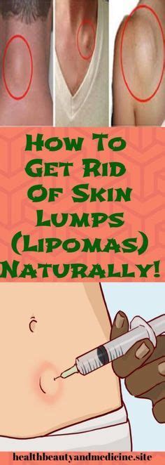 Skin Lumps Usually Appear On The Head Neck Underarm And Arm They Are
