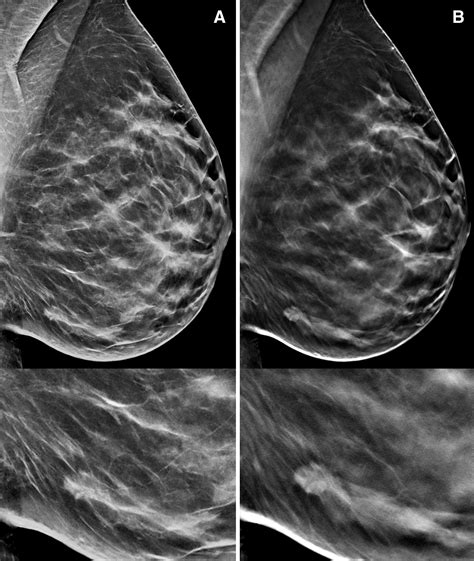 Digital Breast Tomosynthesis And Synthetic 2d Mammography Versus