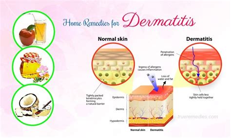 23 Natural Home Remedies For Dermatitis Symptom Relief